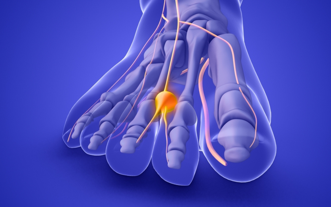 Νεύρωμα Morton